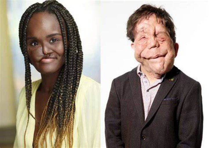 Adam Pearson Height: A Detailed Look into His Life, Career, and Influence