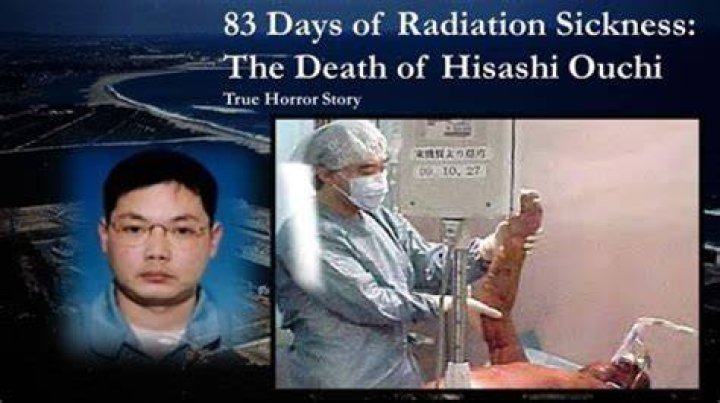 Hisashi Ouchi: The Man Who Survived the Worst Radiation Exposure in History