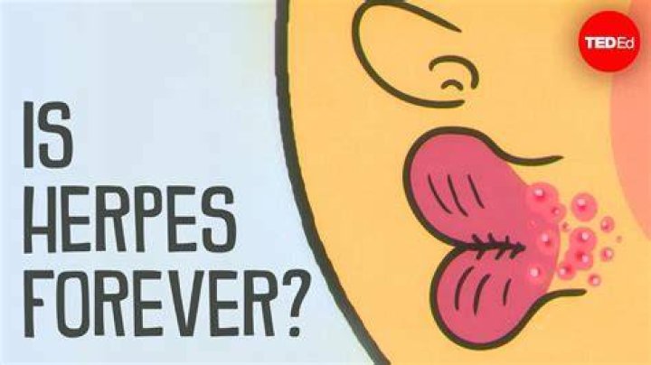 Understanding Herpes: Causes, Symptoms, and Treatment Options