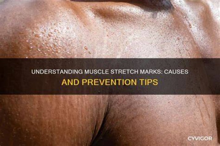 Understanding Rapid Muscle Growth Stretch Marks: Causes, Prevention, and Solutions