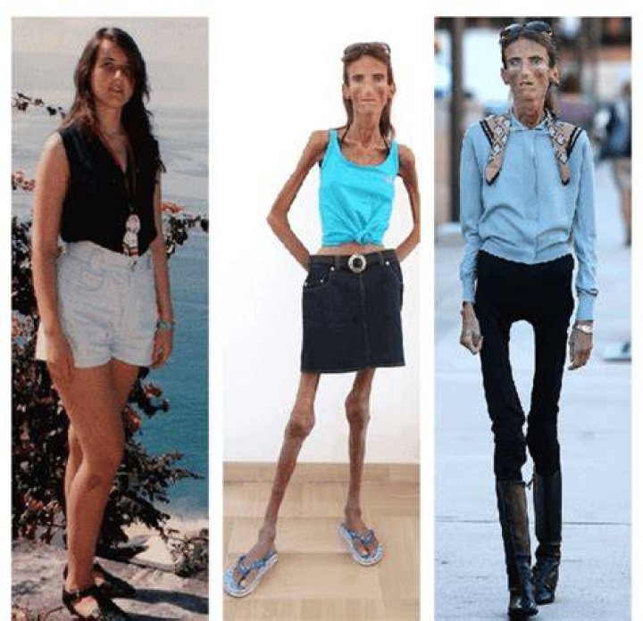 Who is the Most Skinniest Person in the World? Unveiling the Incredible Story