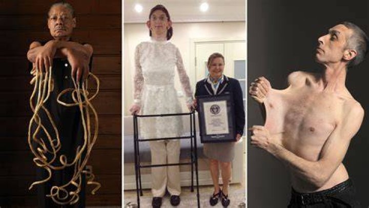 Who is the Most Skinniest Person in the World? Unveiling the Story